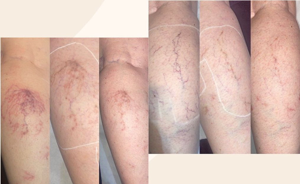 Thread veins on the legs before and after four thread vein removal sessions at Precious Moments Beauty Clinic, Banstead