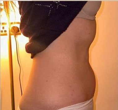 Side profile of the same abdomen after 3D Lipo Ultimate Pro treatments, with a flatter contour