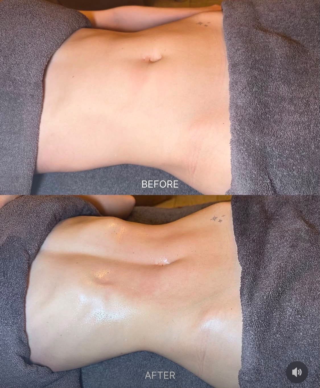 Fat freezing before and after, stomach close-up result at Precious Moments Beauty Clinic, Banstead
