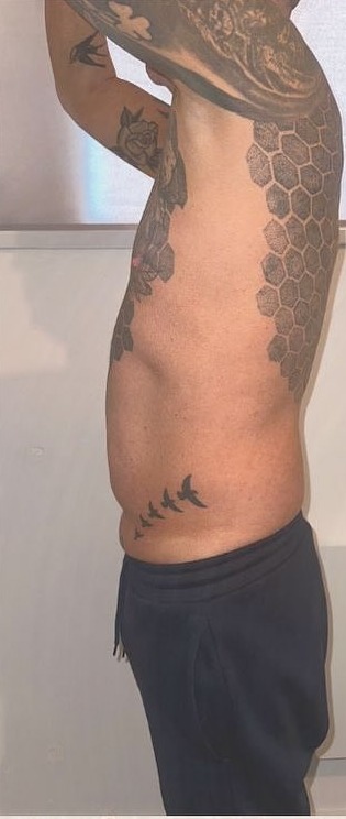 Side view of a male client's stomach before one session of fat freezing at Precious Moments Beauty Clinic, Banstead