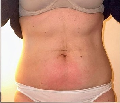 Front view of the same abdomen after a course of 3D Lipo Ultimate Pro treatments, visibly slimmer through the waist
