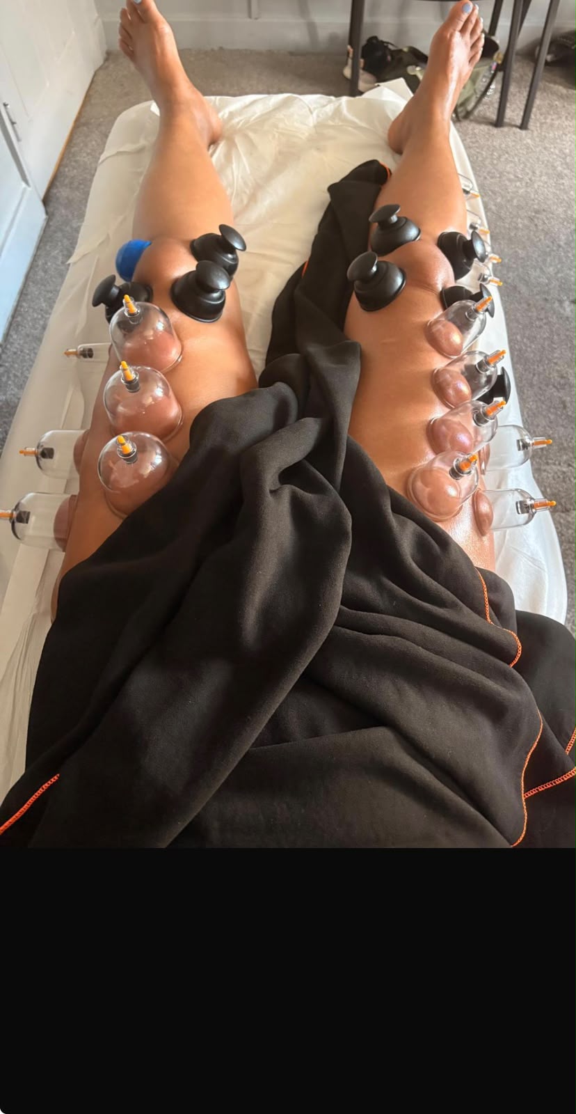 Silicone cupping applied to the legs during Brazilian lymphatic drainage at Precious Moments, Banstead
