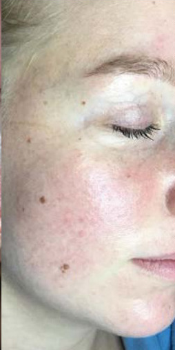 The same client after 10 Dermalux Tri-Wave MD LED sessions, showing calmer, more even skin with reduced redness and inflammation