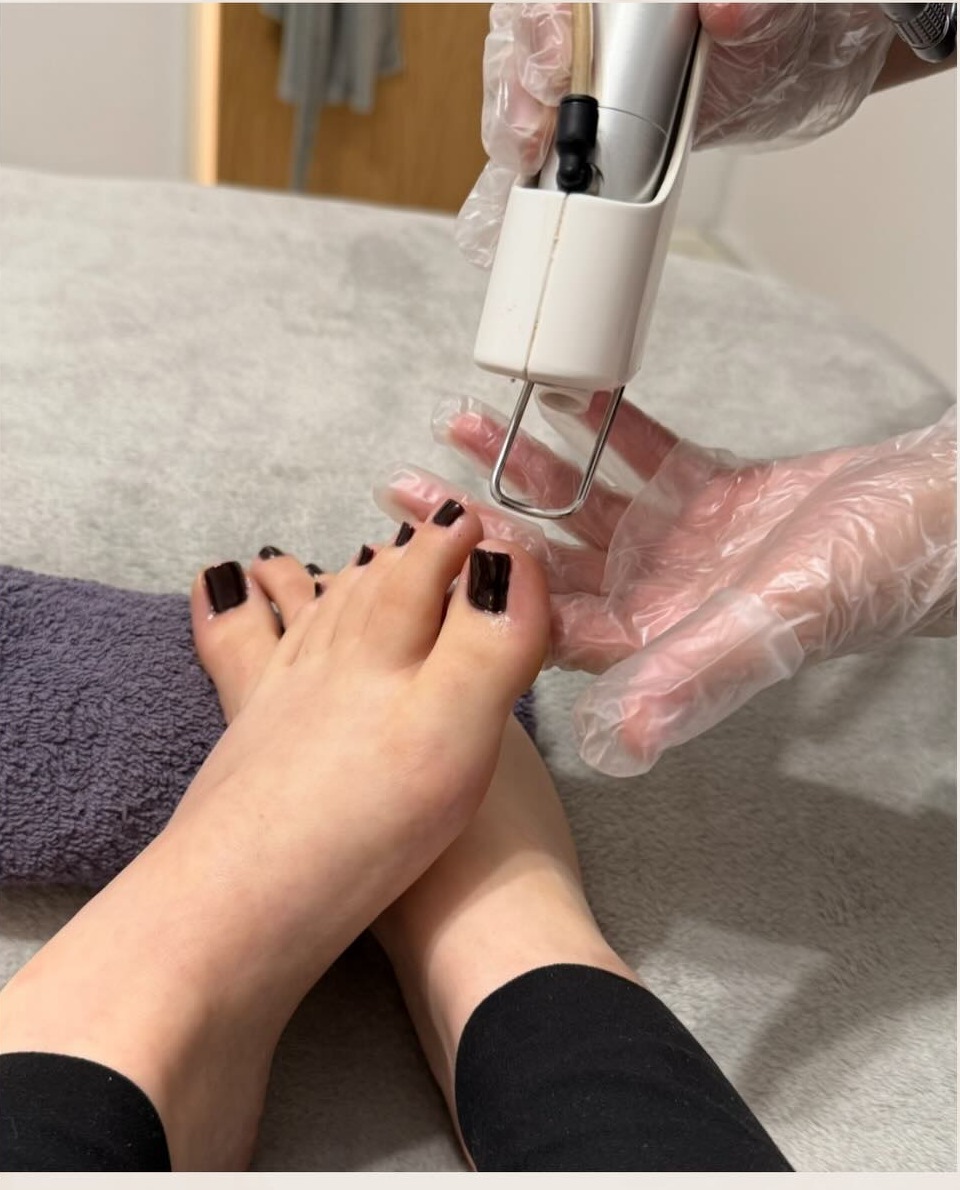 Laser nail fungus removal being carried out on the toenails at Precious Moments Beauty Clinic, Banstead