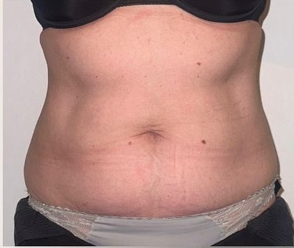 Front view of a client's abdomen before a course of 3D Lipo Ultimate Pro body contouring in Banstead