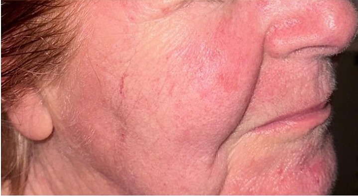 The same cheek and eye area after three Dermaforce sessions, with visibly softer, smoother lines