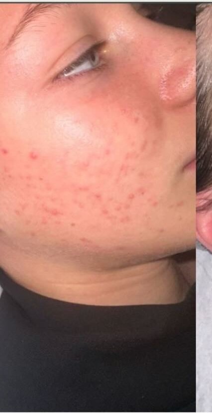 Client's cheek with active breakouts, redness and congestion before starting regular facials with LED light therapy in Banstead