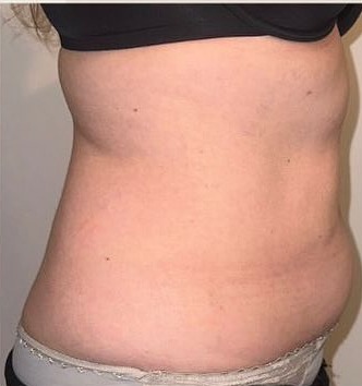 Side profile of a client's abdomen before 3D Lipo Ultimate Pro body contouring at Precious Moments, Banstead