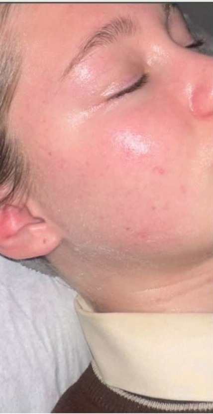 The same client's skin after regular facials with LED light therapy and a skincare plan, clearer and calmer with an even tone