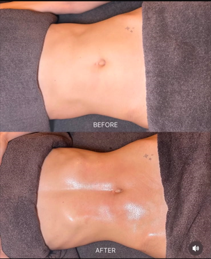 Fat freezing before and after, stomach contour result at Precious Moments Beauty Clinic, Banstead