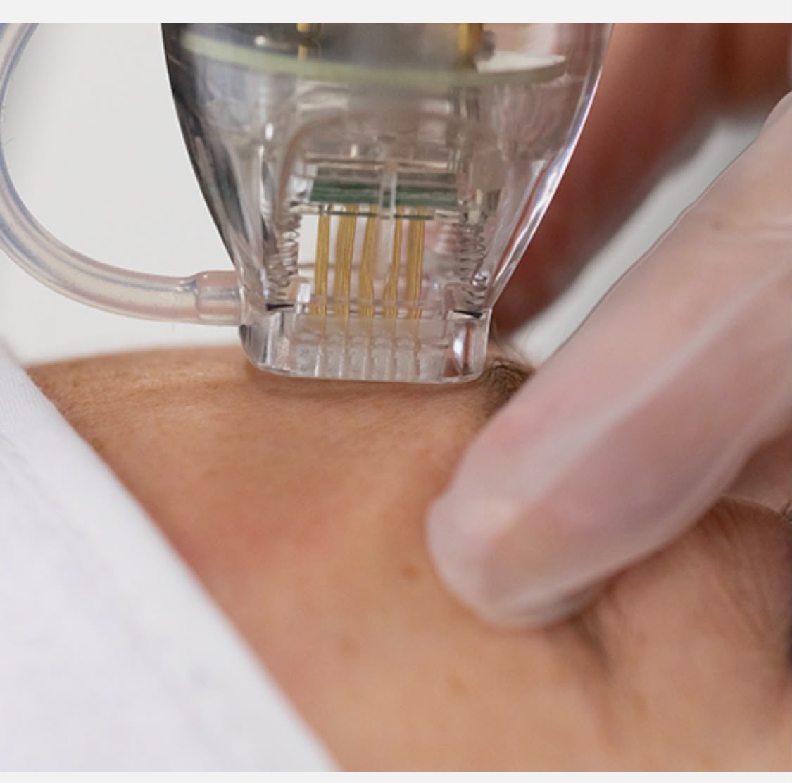 Close-up of a sterile microneedling handpiece treating the skin during medical skin needling at Precious Moments Beauty Clinic, Banstead