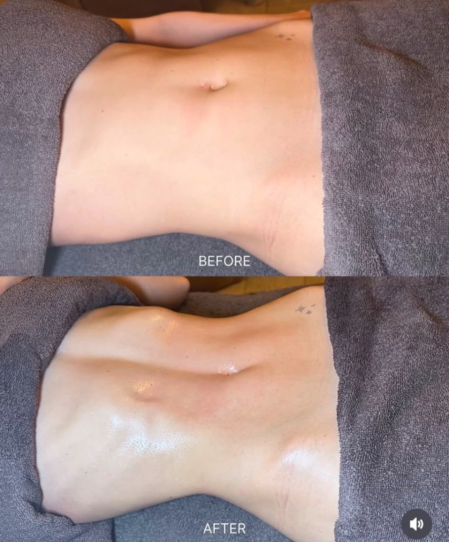 Before and after stomach result from Brazilian lymphatic drainage massage at Precious Moments Beauty Clinic, Banstead