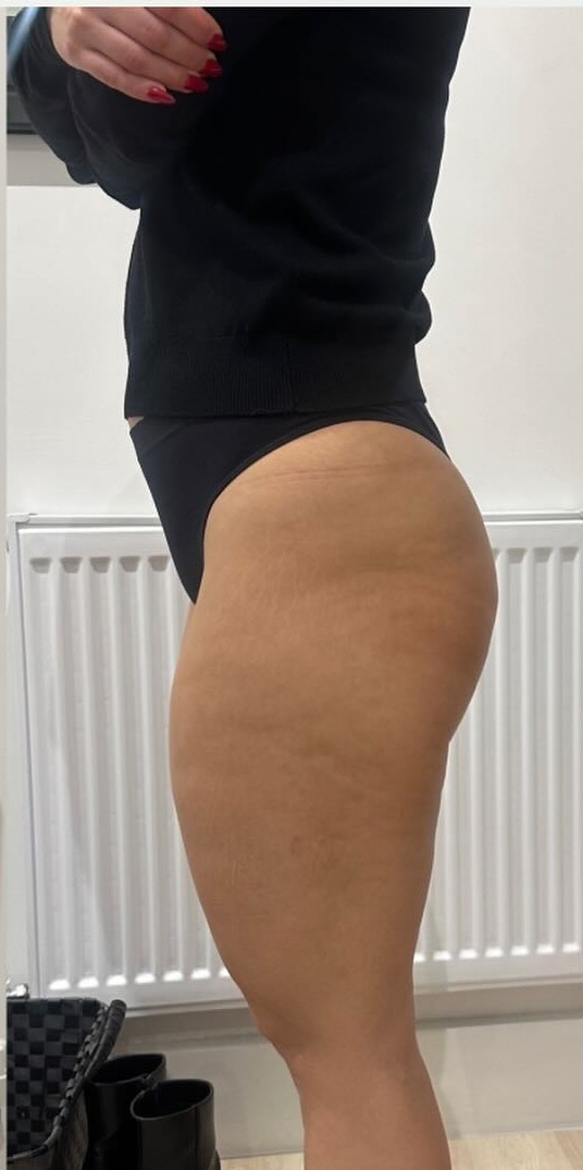 The same client after one 3D Ultimate Pro bum lift session, showing a lifted, smoother contour