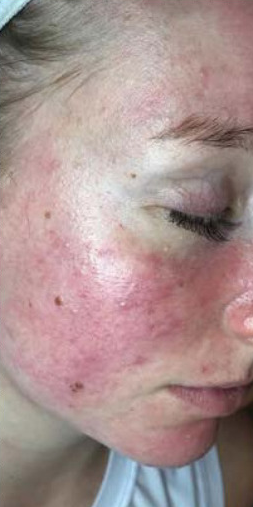 Client with facial redness and rosacea before starting a course of Dermalux Tri-Wave MD LED phototherapy at Precious Moments Beauty Clinic in Banstead