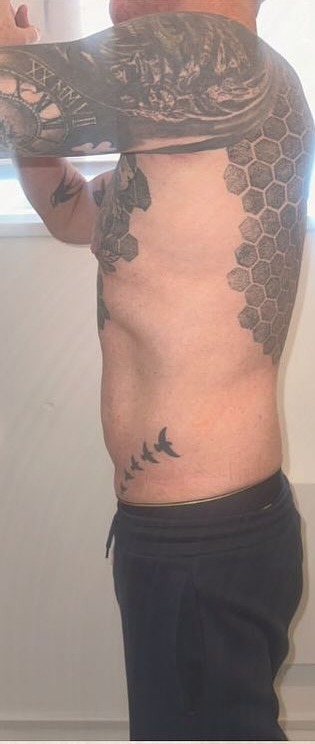 The same client's stomach after one fat freezing session, with a flatter, tighter waistline