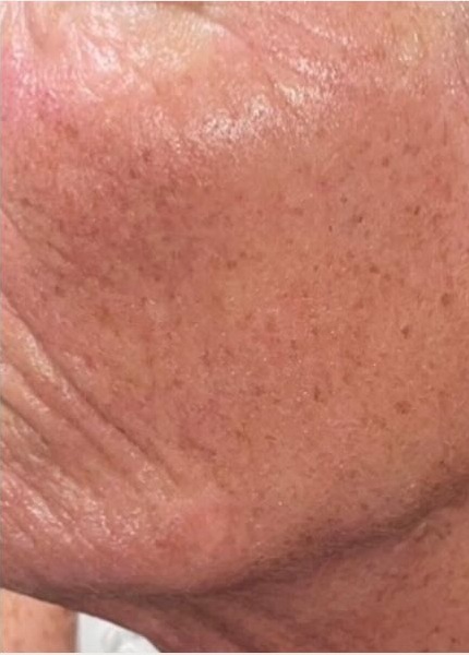 The same cheek after 3D Dermaforce radio-frequency skin needling, showing smoother, plumper and more even texture